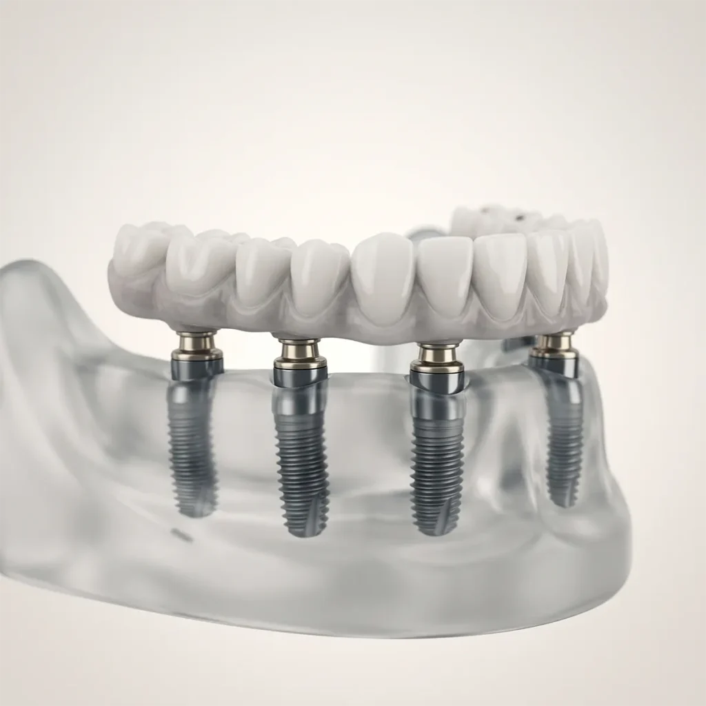 All-on-X Graphical Illustration of Implants