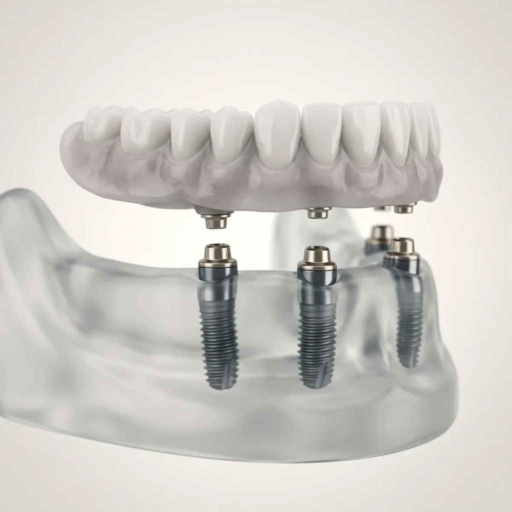 Implant Supported Dentures Graphical Illustration
