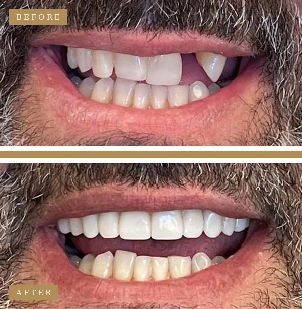 Before & After Dental Implants Patient