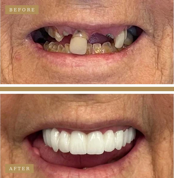 Before & After Full Mouth Dental Implants Patient