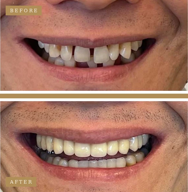 Before & After Full Arch Dental Implants Patient