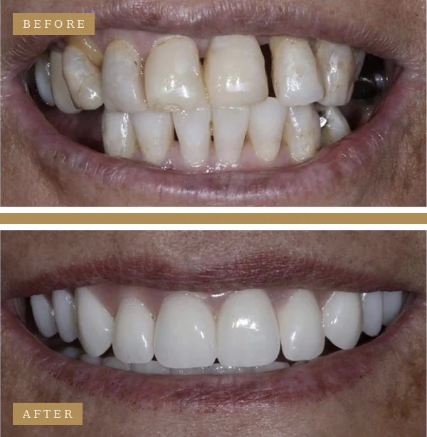 Before & After Dental Implants