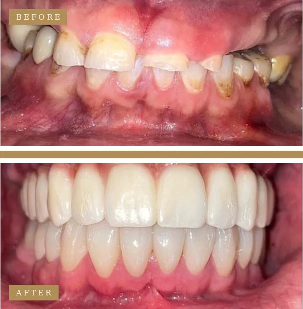 Before & After Upper Arch Dental Implants Patient
