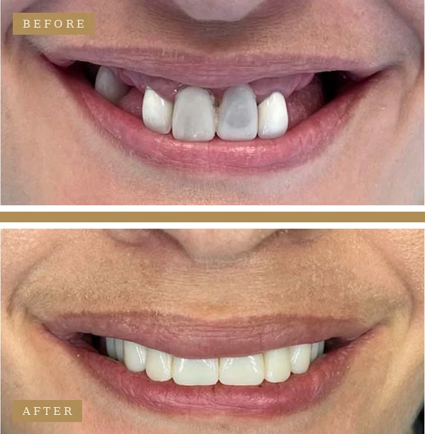 Before & After Upper & Lower Arch Dental Implants Patient