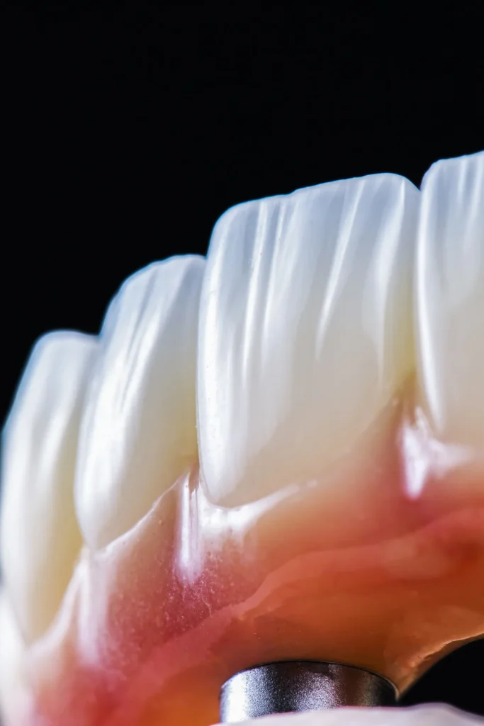 All On X Full Arch Implants