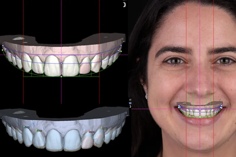 Digital Smile Design